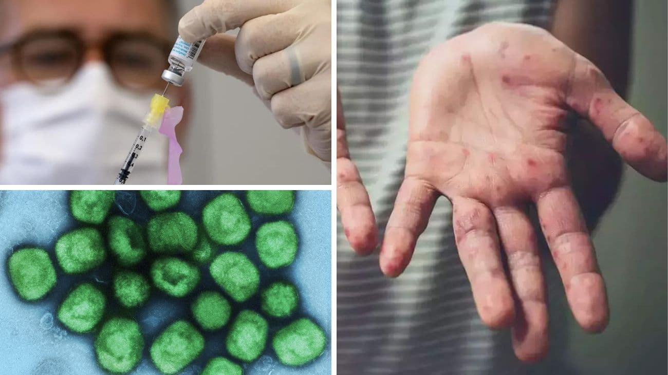 Viruela del mono: la historia del virus MPXV, desde un laboratorio nórdico a la "emergencia sanitaria mundial"